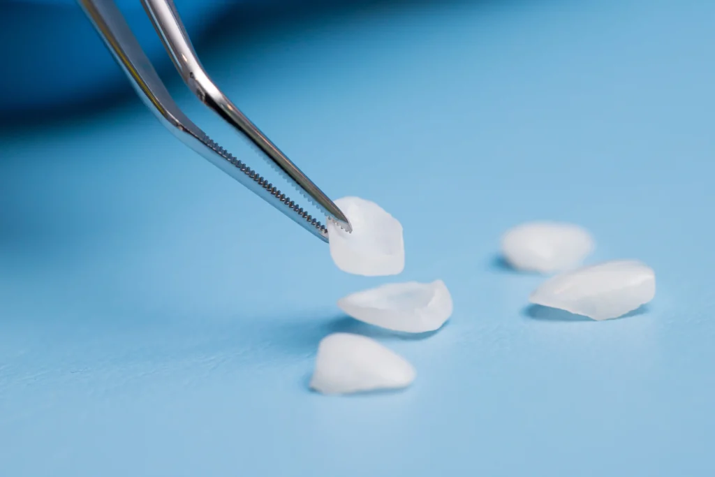 Come cambiano i denti con le faccette dentali