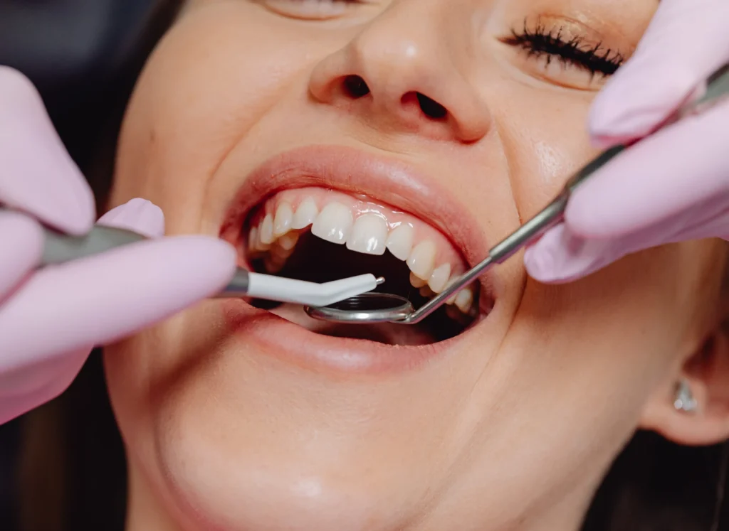 Ogni quanto fare la pulizia dentale